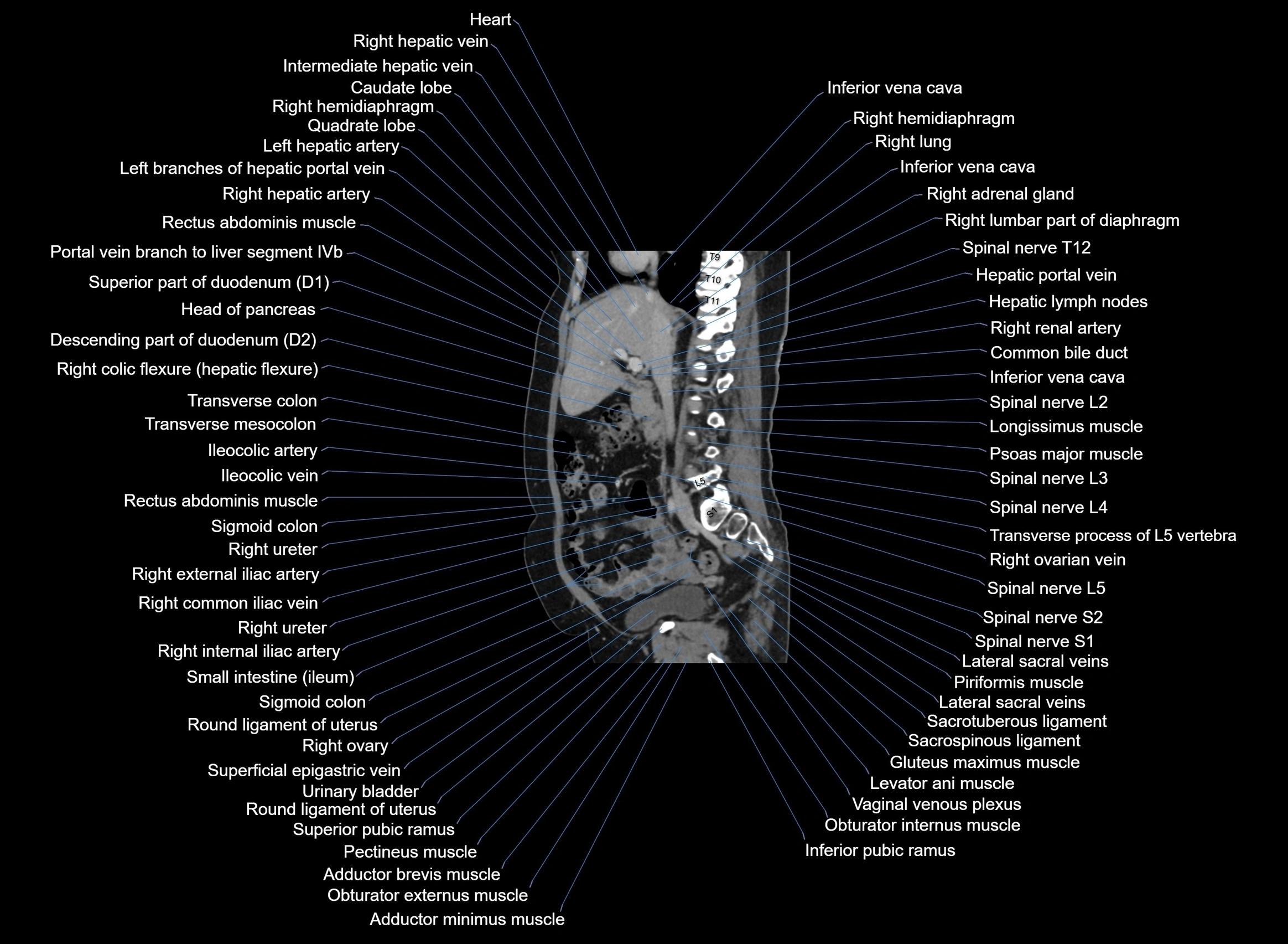 CT Abdomen sagittal cross sectional anatomy labelled radiology image -00069.webp